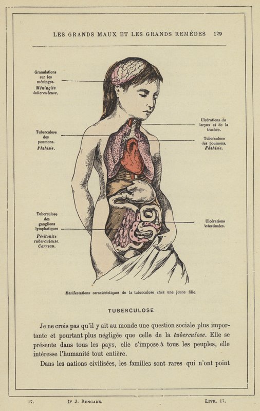 Manifestações características da tuberculose numa jovem rapariga (cor litho) de French School