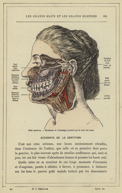 Nervos dentários, Mecanismo de odontologia produzido pela cárie dentária (cor litho) de French School