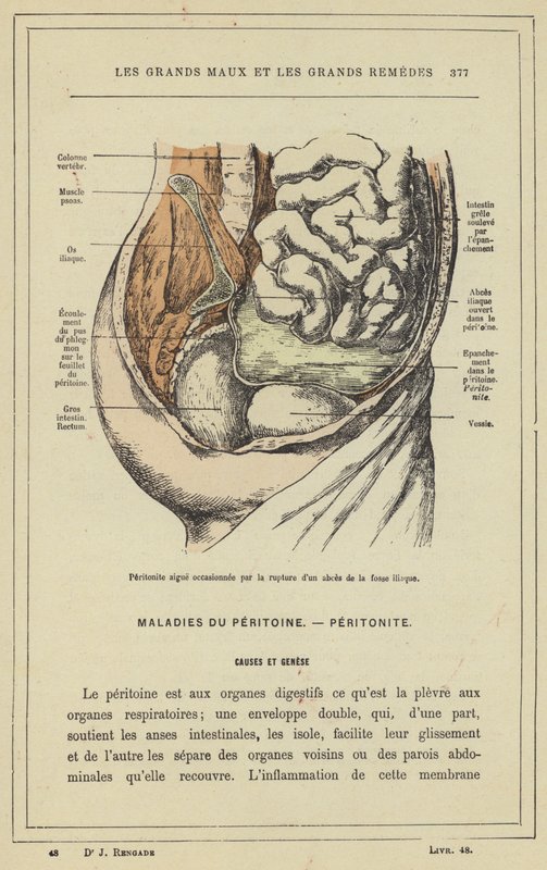 Peritonite aguda causada pela ruptura de um abcesso de fossa ilíaca (cor litho) de French School