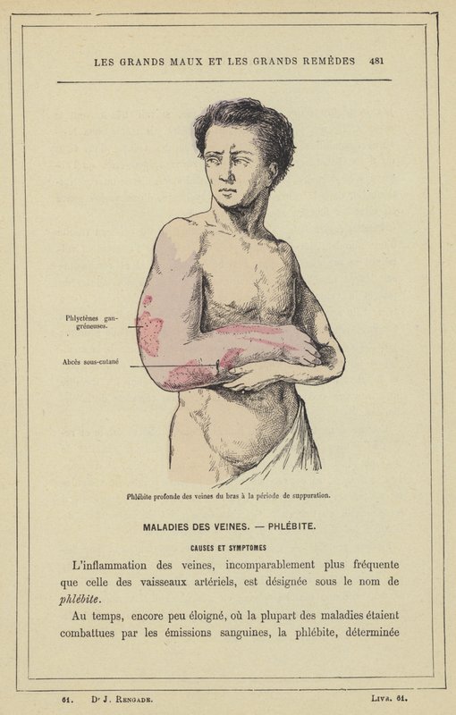 Flebite profunda das veias dos braços durante o período de supuração (cor litho) de French School