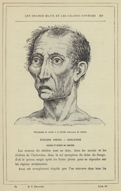 Fisiognomia do paciente durante o período de asfixia da cólera (cor litho) de French School
