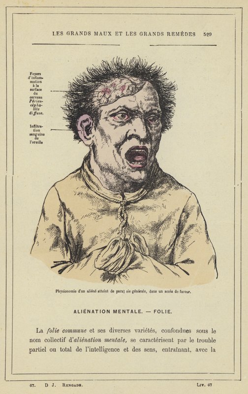 Fisiognomia de um estrangeiro que sofre de paralisia geral, em um ataque de raiva (cor litho) de French School