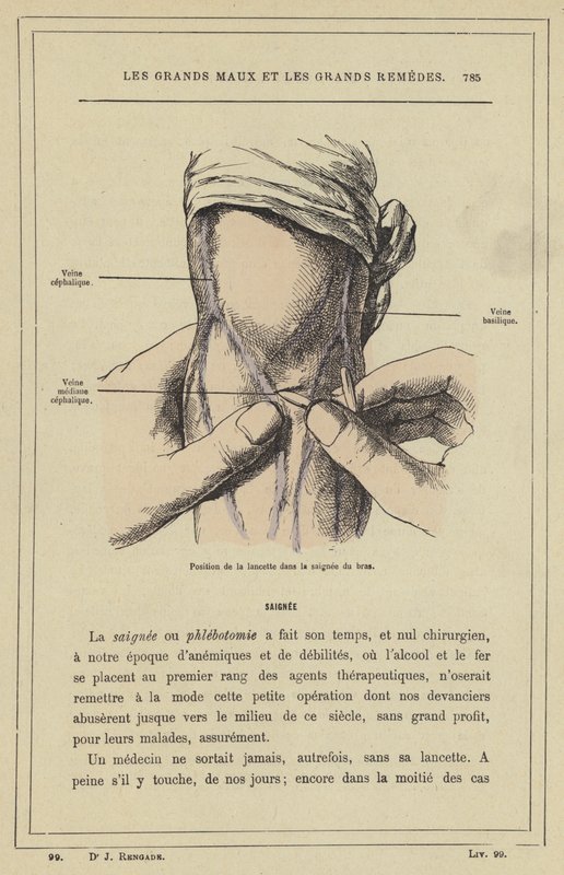 Posição da lanceta no braço que sangra (cor litho) de French School