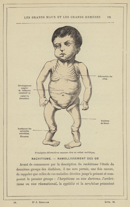 Principais deformações ósseas de uma criança com raquitismo (cor litho) de French School