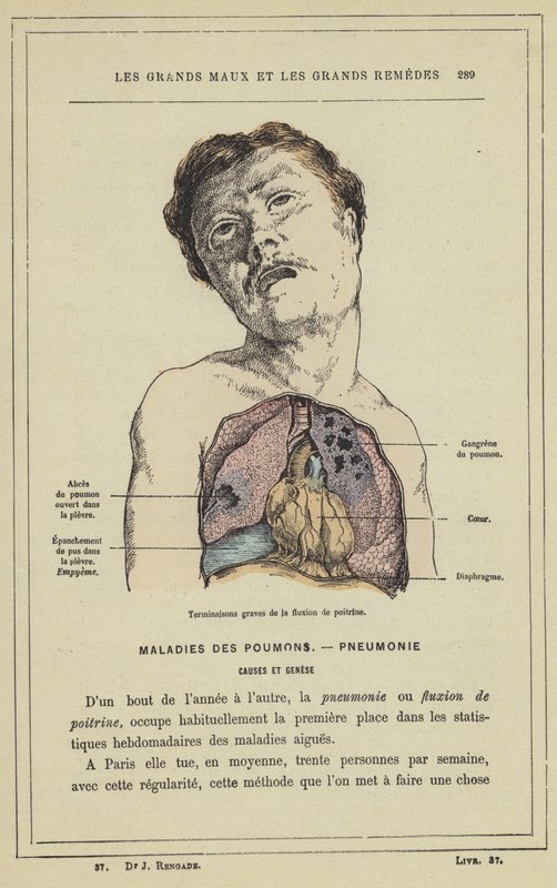 Terminações severas de fluxion de poitrine (cor litho) de French School