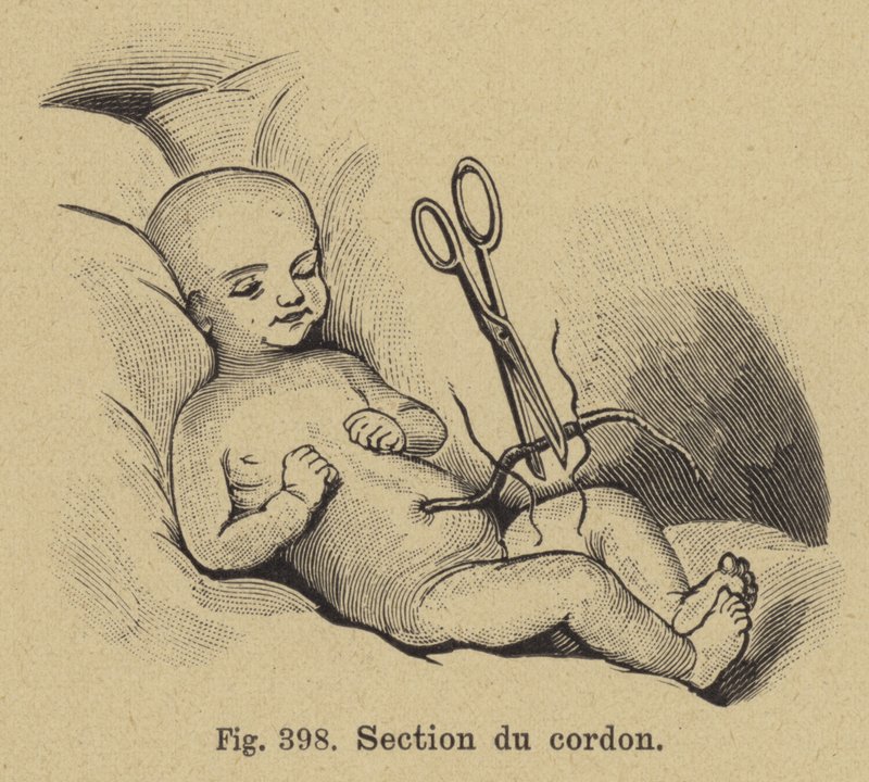 Corte de um cordão umbilical de recém-nascido babys de German School