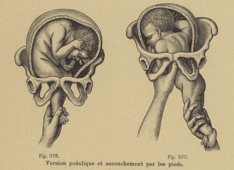 Entregando os pés de um bebê primeiro (parto pélvico) de German School