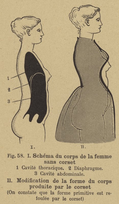 Diagrama mostrando o efeito do uso de um espartilho na forma do corpo de uma mulher de German School
