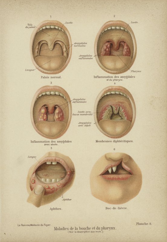 Doenças e distúrbios da boca e garganta (cor litho) de German School