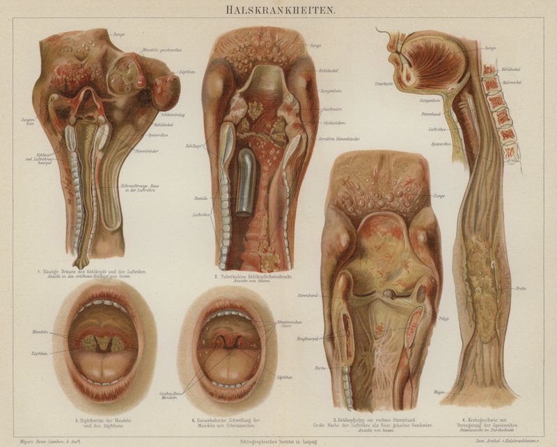 Doenças da garganta (cor litho) de German School