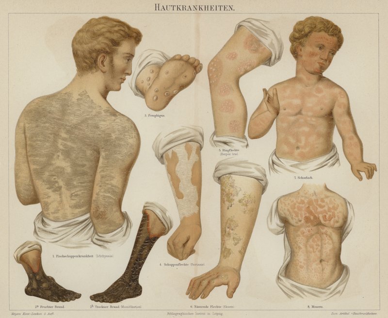 Distúrbios cutâneos (cor litho) de German School