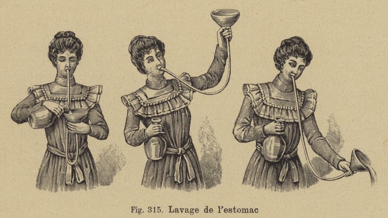 Lavando o estômago de German School