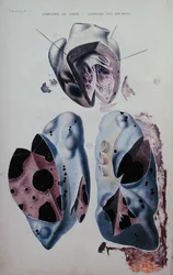 Apoplexia do coração e dos pulmões, placa ilustrativa de "Anatomie pathologique du corps humain" de Jean Cruveilhier (1791-1874), publicado em Paris