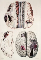 Apoplexia capilar, de 