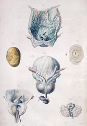 Doenças da bexiga e da próstata, de "Anatomie Pathologique du Corps Humain" de Jean Cruveilhier (1791-1874) 1828-42 (gravura colorida)