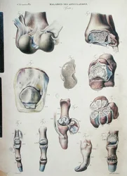Doenças das articulações, de "Anatomie Pathologique du Corps Humain" de Jean Cruveilhier (1791-1874) 1828-42 (gravura colorida)