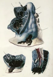 Doenças pulmonares, de "Anatomie Pathologique du Corps Humain" de Jean Cruveilhier (1791-1874) 1828-42 (gravura colorida)
