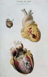 Placa retratando doenças cardíacas. Ruptura espontânea do coração de uma mulher de 86 anos (fig. 1) e pericardite num bebé de seis dias (fig. 2), de "Anatomie pathologique du corps humain" de Jean Cruveilhier (1791-1874), publicado em Paris.