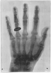 Radiografia da mão esquerda de Anna Bertha Ludwig, mulher de Röntgen