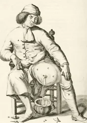 Drenagem do fluido a partir de um abcesso, a partir dos exercícios práticos para curar método por Frederic Dekkers, 1694