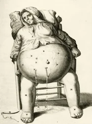 Drenagem do fluido a partir de um abcesso, a partir dos exercícios práticos para curar método por Frederic Dekkers, 1694