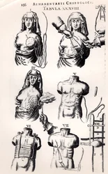 Operação a cancro da mama, de Armamentarii Chirurgici de Johannes Schultes (1595-1645), publicado em Amesterdão, 1672