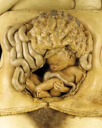 Modelo anatómico de uma gravidez ovariana, detalhe (cera) (ver também 1126545-7)