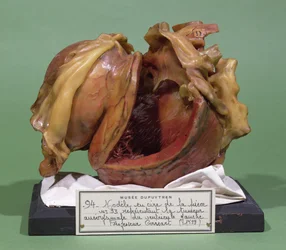 Modelo de um tumor do ventrículo esquerdo, 1799 (cera)
