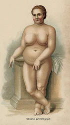 Retrato de uma mulher com obesidade patológica (impressão)