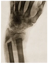 Raio X de um pulso fraturado c.1890