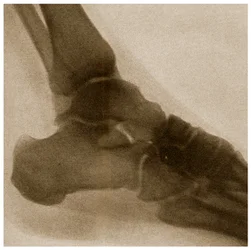 Raio X de um tornozelo c.1890
