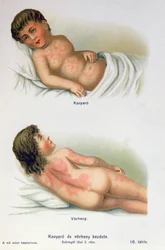 Sarampo e febre escarlate, de um livro médico de família, c.1900