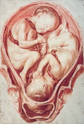 Ms Hunter 654 Placa 10 Desenho de um conjunto de desenhos de obstetrícia para as tabelas de obstetrícia de William Smellie (1697-1763) (giz sobre papel)