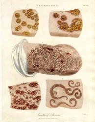 Alterações patológicas da pele: Variedades de psoríase