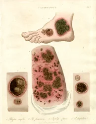 Doenças patológicas da pele - Pitiríase, Impetigo e Sífilis