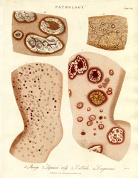 Condições patológicas da pele: Schurigie; Pele leprosa; Pallada e Impetigo