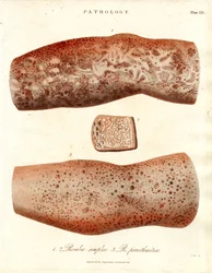 Erupções cutâneas - Roseola simplex e Roseola paristhmitica
