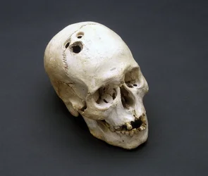 Crânio trepanado da Idade do Bronze, Jericó, Palestina, 2200-2000 a.C.