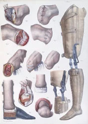 Amputações e próteses, placa do "Tratado Completo sobre a Anatomia do Homem", de Jean-Baptiste Marc Bourgery (1797-1849) 1866-67