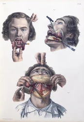 Operação à mandíbula inferior, prancha do «Tratado completo da anatomia do homem» de Jean-Baptiste Marc Bourgery (1797-1849), 1866-67