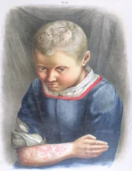 Favus, de um livro de Daniel Cornelius Danielssen (1815-94) 1892
