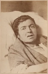 Epilepsia histérica, face de contração, placa VIII de &39;Iconografia fotográfica de La Salpetriere&39; por Bourneville e P. Regnard, Paris, 1876 (impressão albumen)