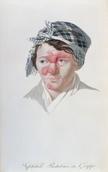 Pústulas de aglomerado sífilis, de um livro do barão Jean Louis Alibert (1768-1837) 1838