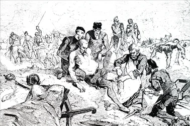Ambroise Pare amarrar as artérias após a amputação.