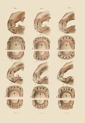 Descrição da placa mostrando a idade, conforme indicado pelos dentes, c1879.