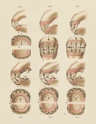 Descrição da placa mostrando a idade, conforme indicado pelos dentes, c1879.