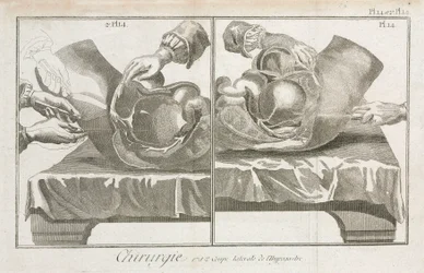 Equipamento, Cirurgia Abdominal Preco-moderna