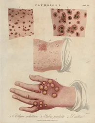 Úlcera cutânea, sarna purulenta e sarna causada por um ácaro sarcóptico scabiei - Litografia de John Pass, publicada na "Encyclopedia Londinensis" de John Wilkes, edição de J. Adlard, Londres
