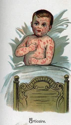 Doenças das crianças: Urticária. In" The new natural medicine" de F.E. Bilz.