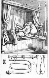 Clystère (para enemas) por Johannes Sculptetus "Armamentarium Surgical". Veneza 1665